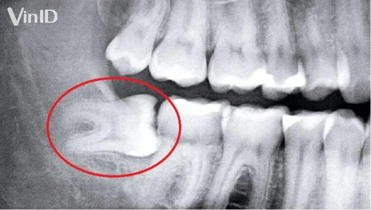 Chỉ có chụp X-quang mới xác định được cách xử lý đúng với tình huống răng khôn mọc lệch