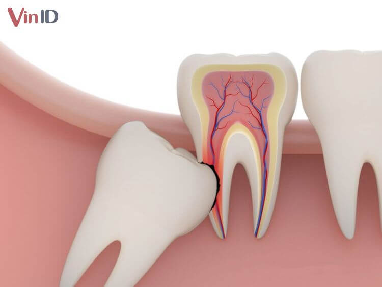 Có nhiều nguyên nhân khiến răng khôn bị mọc lệch