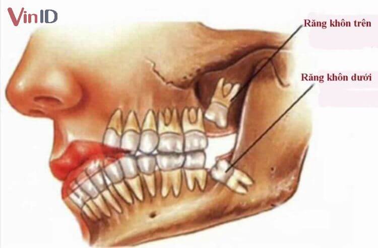 Răng khôn mọc lệch hàm trên thường ít gặp hơn hàm dưới 