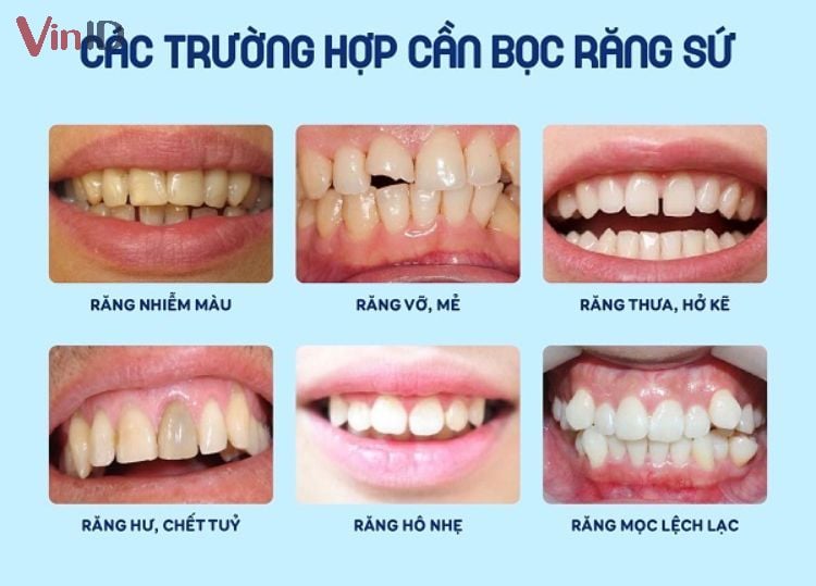 Bọc răng sứ