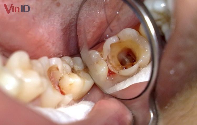 Răng nhiễm trùng