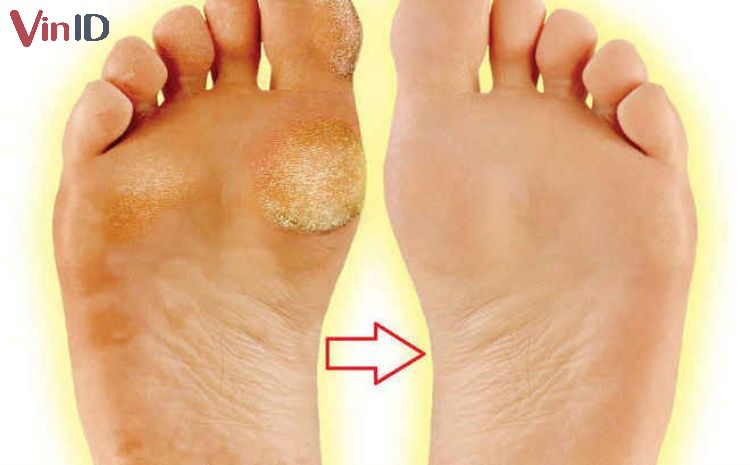 Ngâm chân nước muối giúp trị nấm hiệu quả