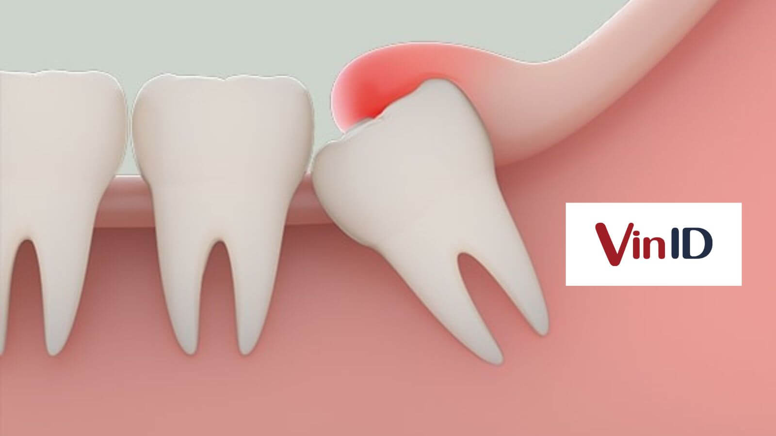 Làm thế nào để giảm đau sau khi nhổ răng khôn?