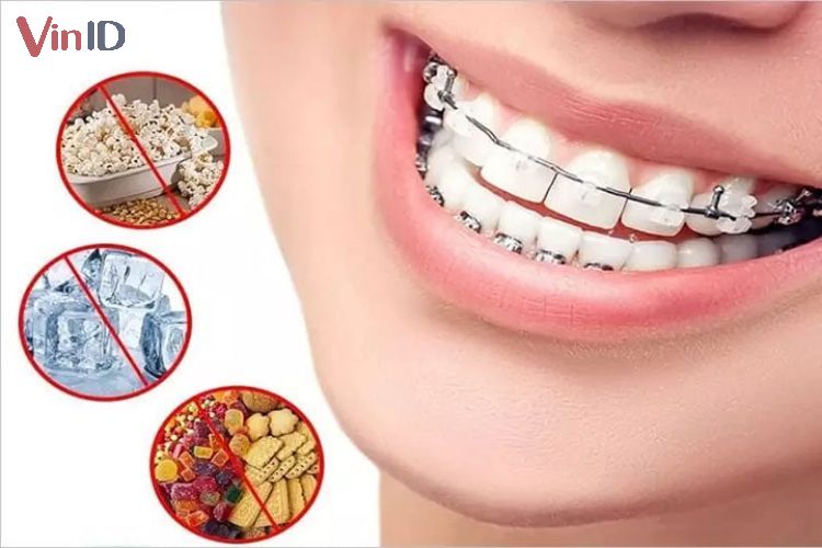 Răng niềng không nên tiêu thụ đồ ăn cứng