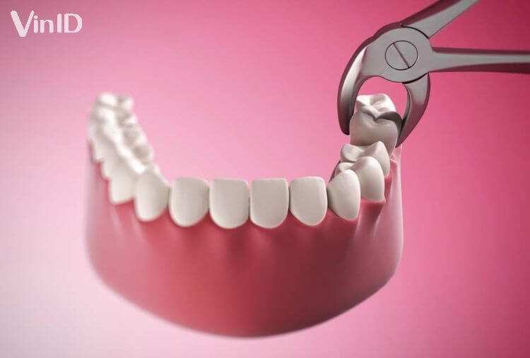 Bạn nên thăm khám kỹ lưỡng trước khi nhổ răng để nha sĩ đưa ra phương pháp nhổ răng phù hợp nhất.